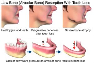 Applebay Family Dental | Dentist in Niagara Falls, ON.|jaw-bone-loss-768×527
