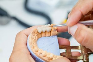 Applebay Family Dental | Dentist in Niagara Falls, ON.|dental-bridge